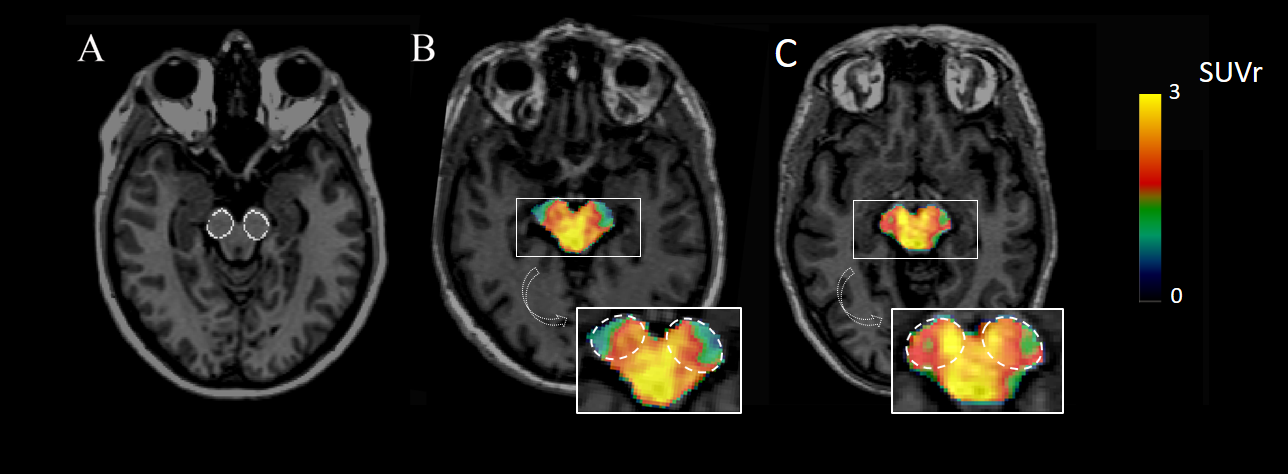Neuroinflammation témoin vs patient PD.png