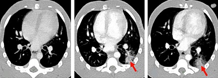 La Covid-19 cause des lésions pulmonaires visibles en imagerie TEP-TDM 